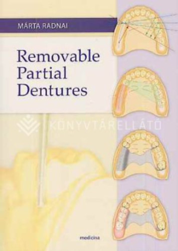 Removable partial dentures