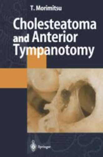 Cholesteatoma and anterior tympanotomy