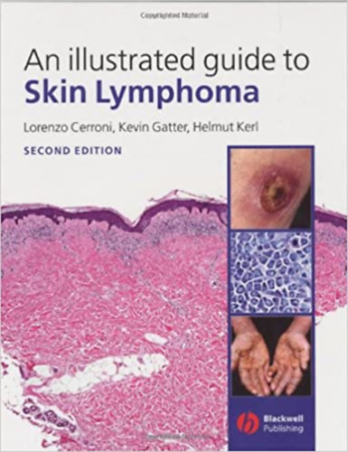 Kevin Gatter, Helmut Kerl Lorenzo Cerroni - An Illustrated Guide To Skin Lymphoma
