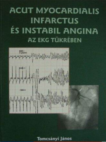 Acut myocardialis infarctus s instabil angina az EKG tkrben