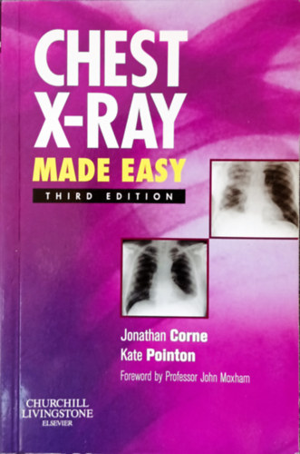 Chest X-ray - Made easy