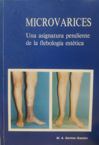Microvarices: Una asignatura pendiente de la flebolog�a est�tica (Industrias Graficas Gracia)